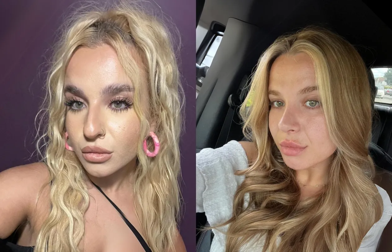 Rhinoplasty — before and after