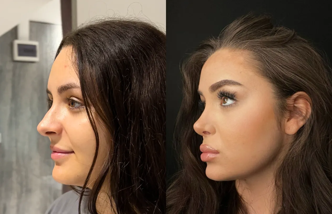 Rhinoplasty — before and after