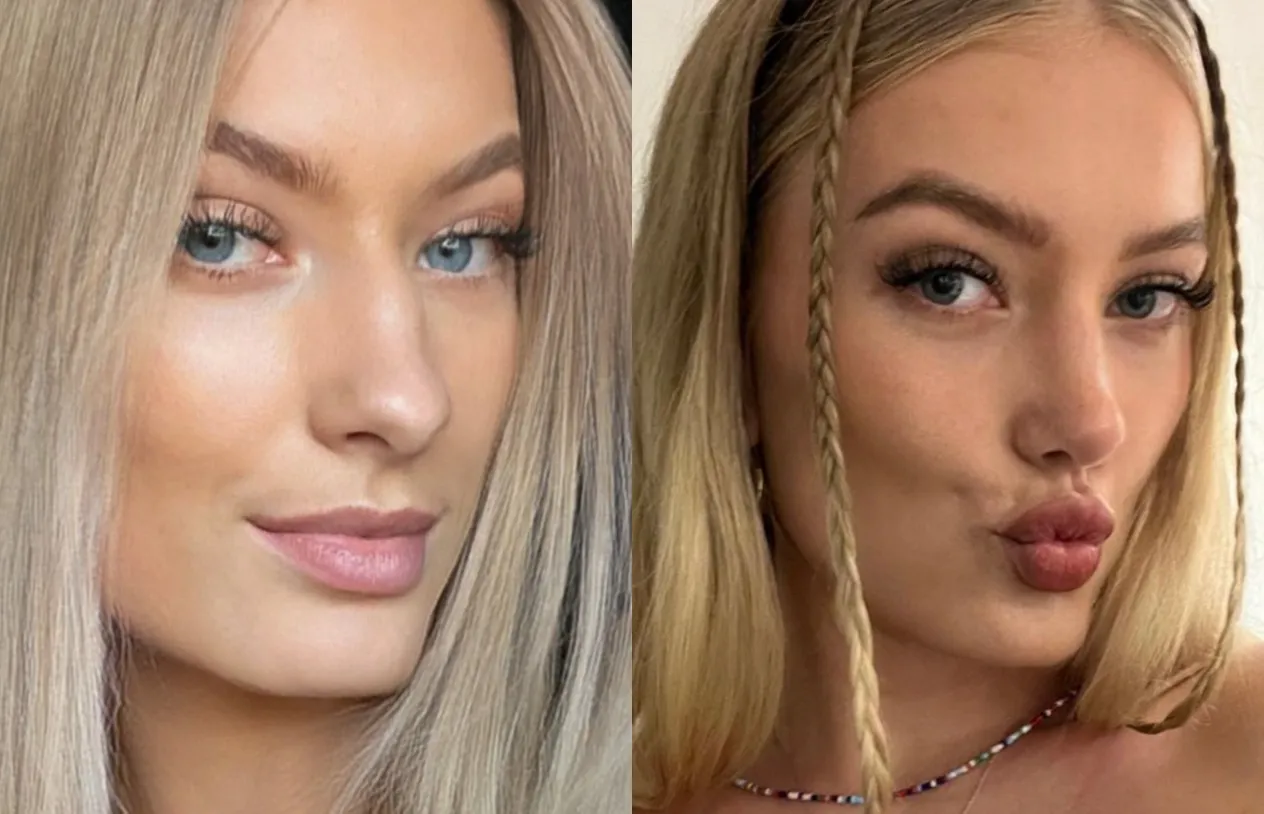 Rhinoplasty — before and after