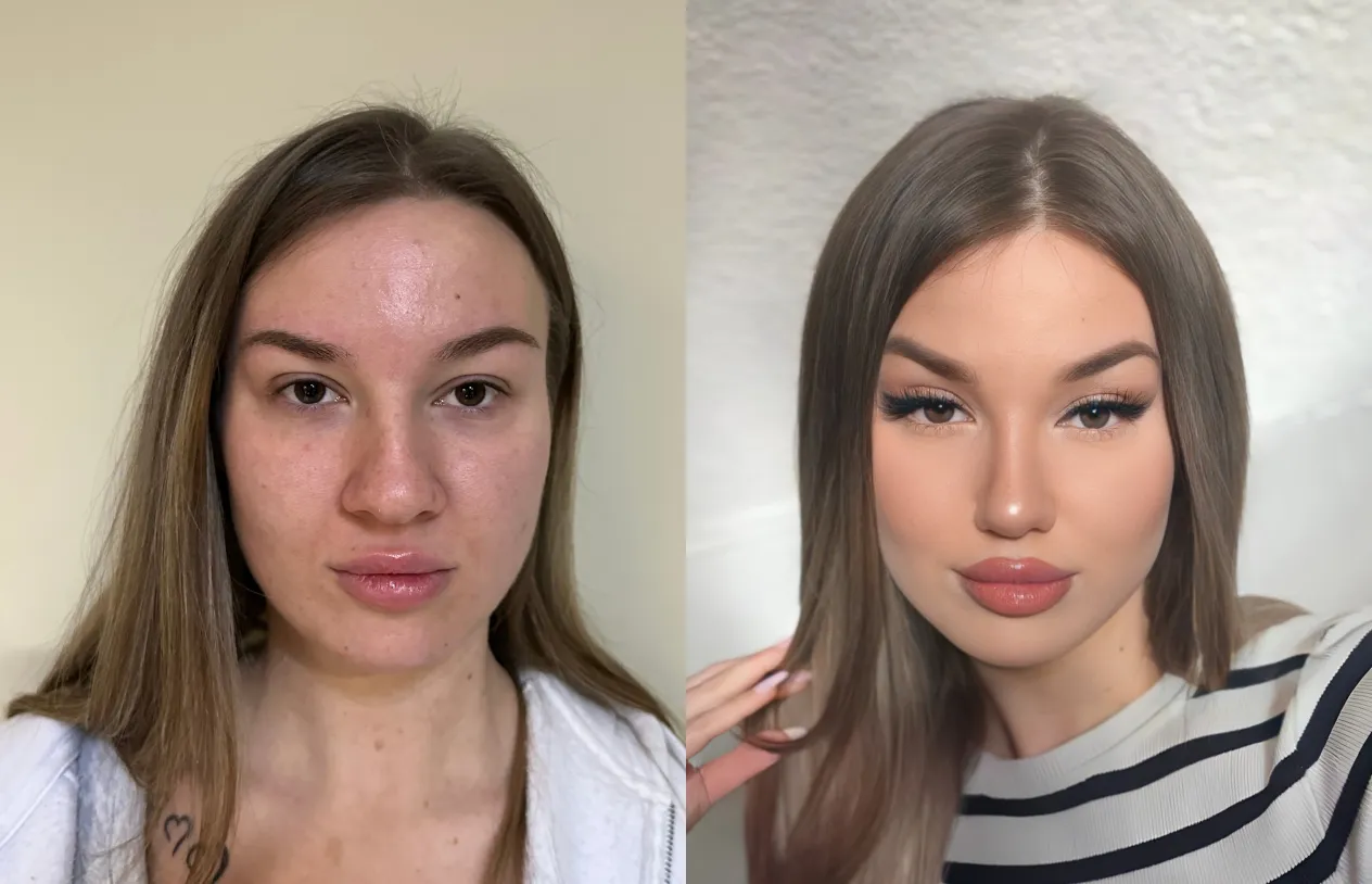 Rhinoplasty — before and after