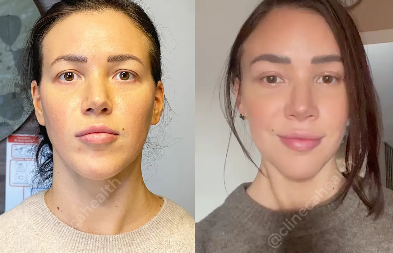Eyelid Surgery — before and after