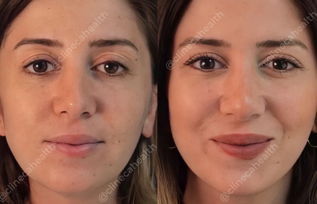 Eyelid Surgery — before and after