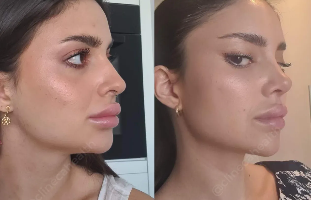 Eyelid Surgery — before and after
