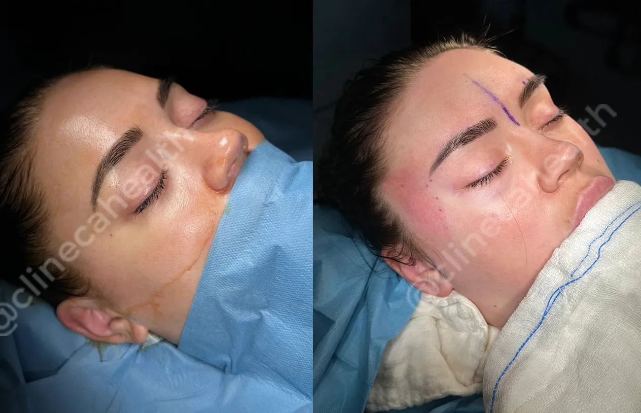 Brow Lift — before and after