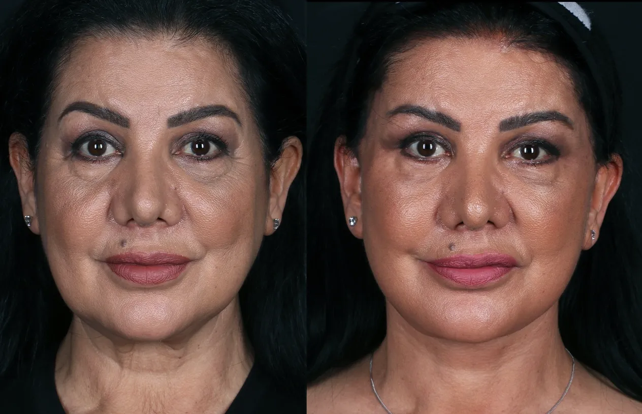 Brow Lift — before and after