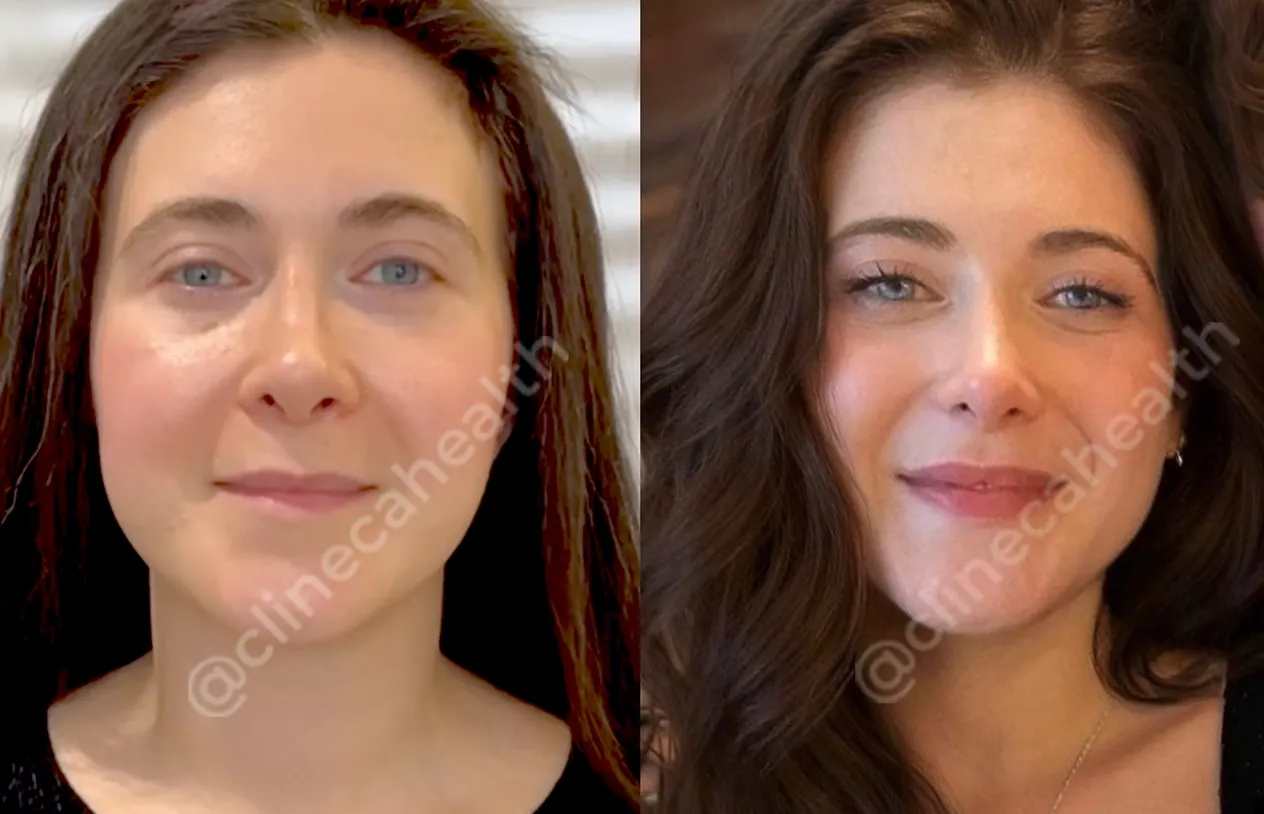 Brow Lift — before and after