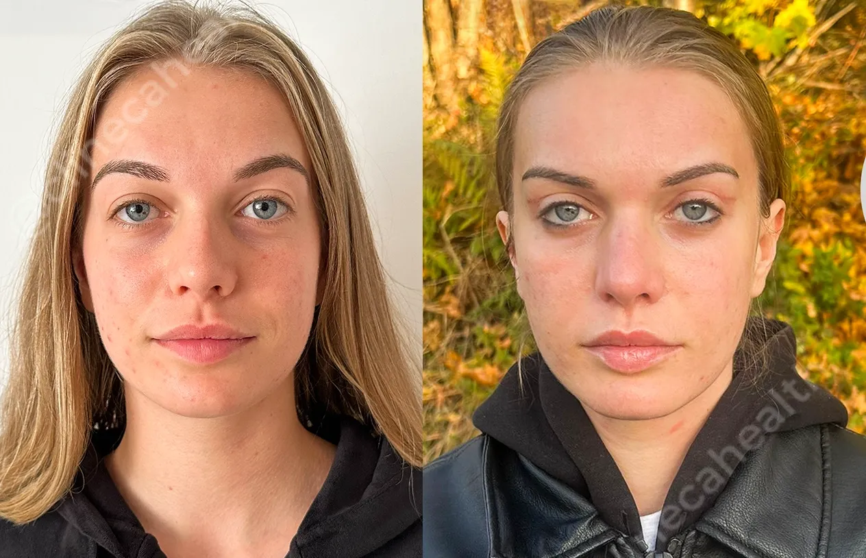 Brow Lift — before and after