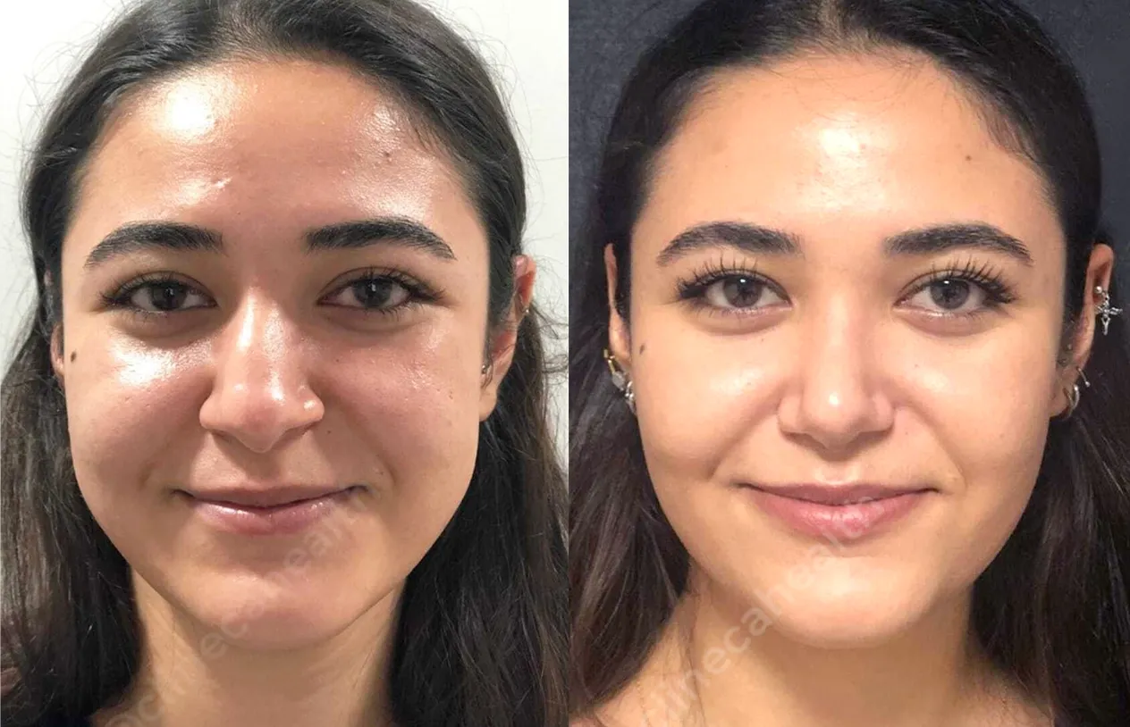 Buccal Fat Removal — before and after