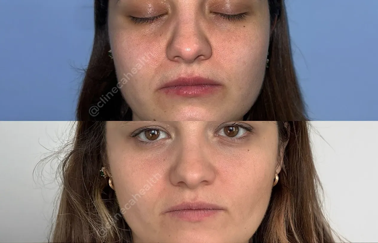 Buccal Fat Removal — before and after