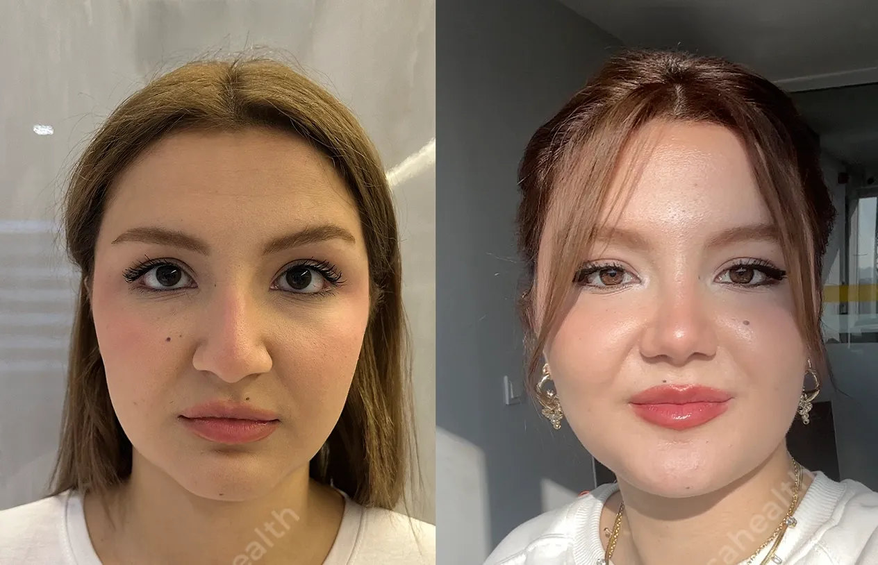 Buccal Fat Removal — before and after