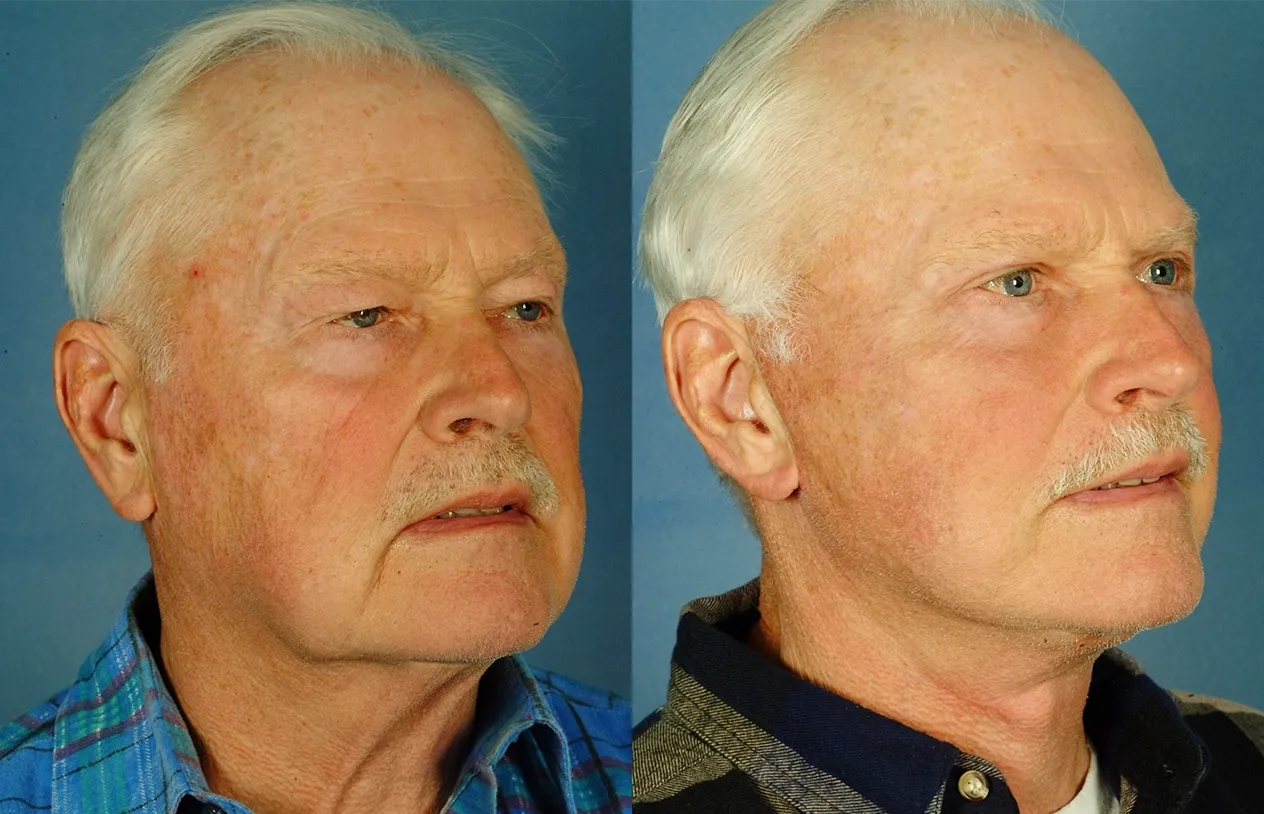 Facelift — before and after