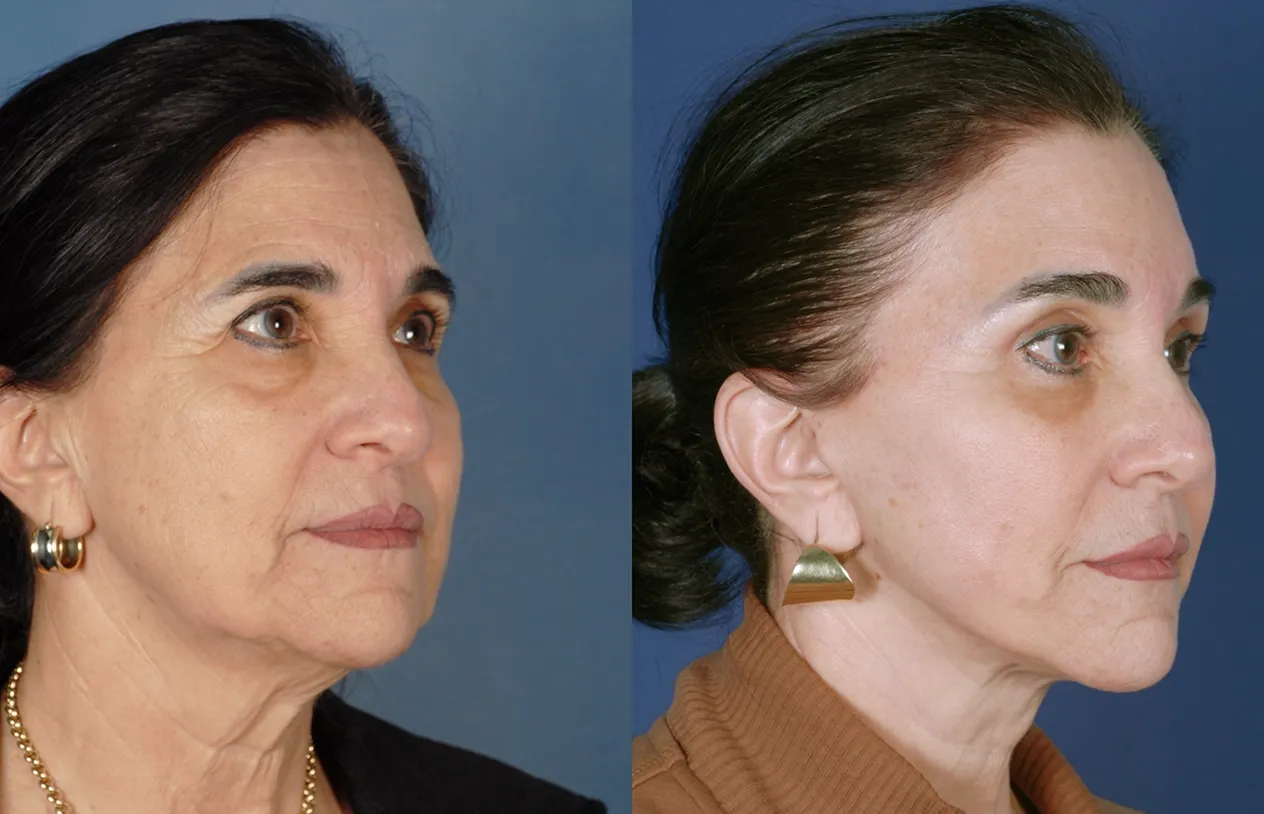 Facelift — before and after