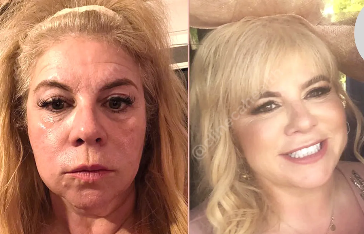 Facelift — before and after