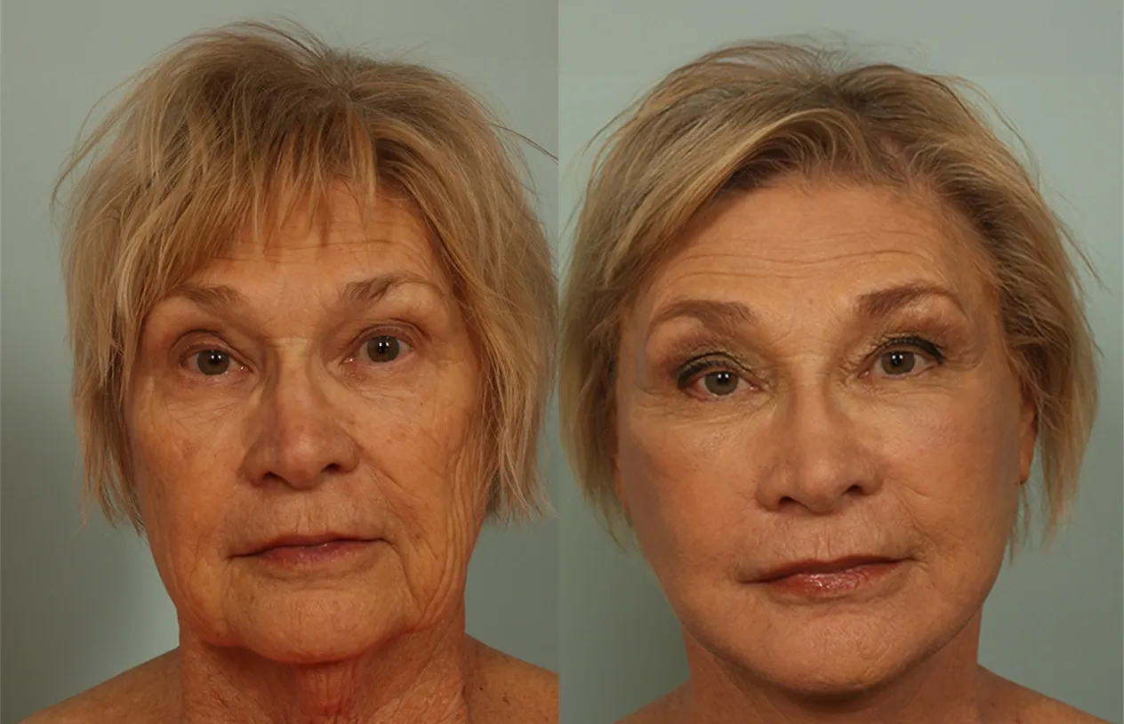 Facelift — before and after
