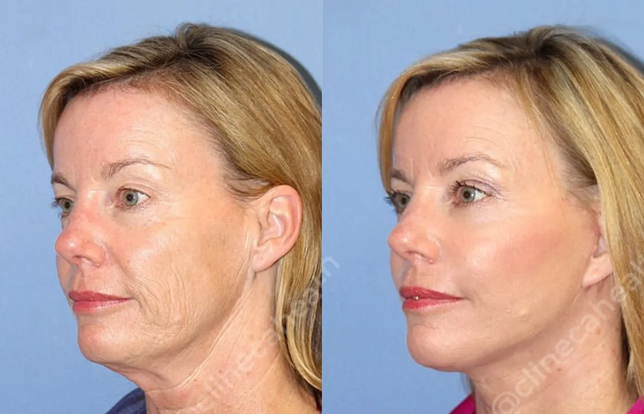 Neck Lift — before and after