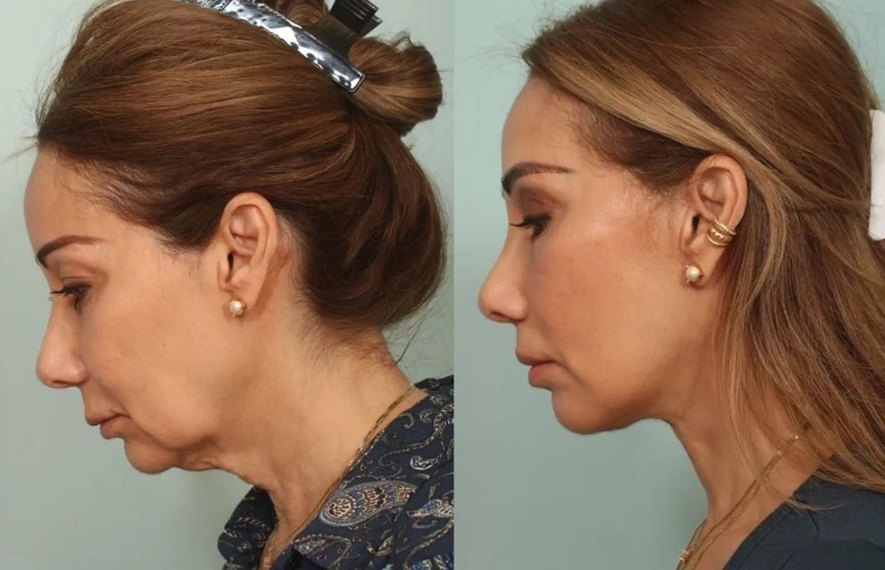 Neck Lift — before and after