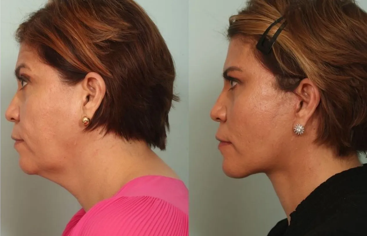 Neck Lift — before and after