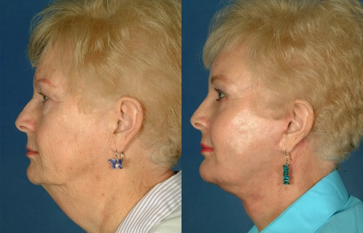 Neck Lift — before and after