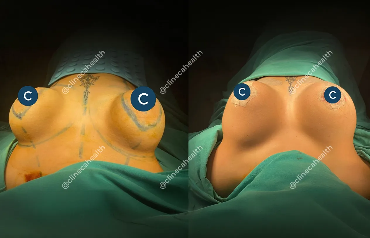 Breast Implant Revision — before and after