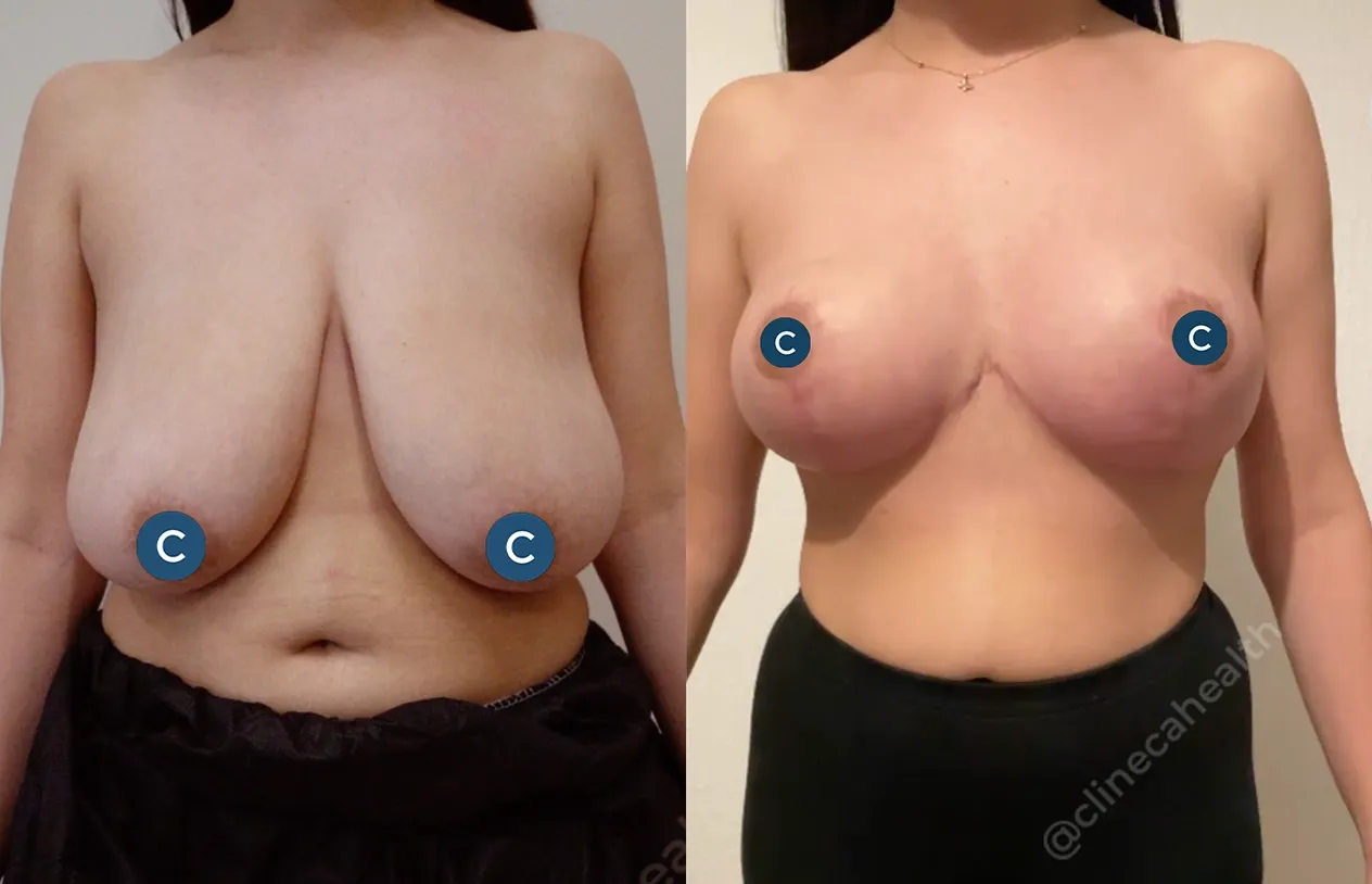 Breast Reduction — before and after