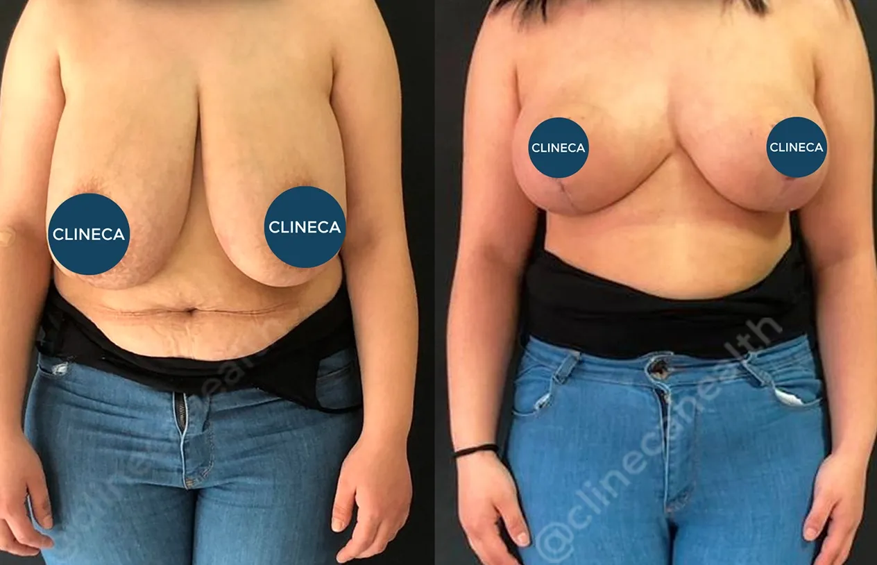 Breast Reduction — before and after