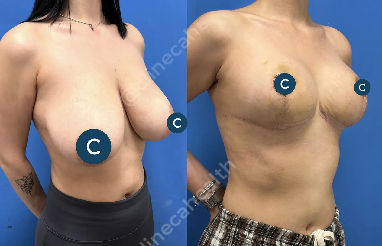 Breast Reduction — before and after