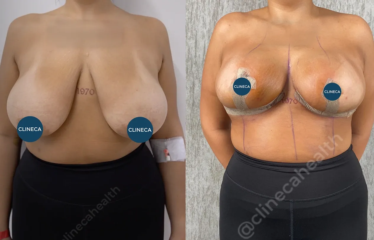 Breast Reduction — before and after