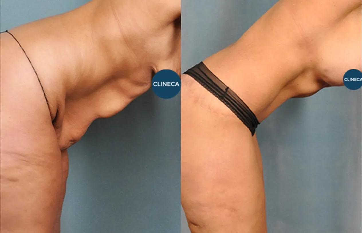 Body Lift — before and after