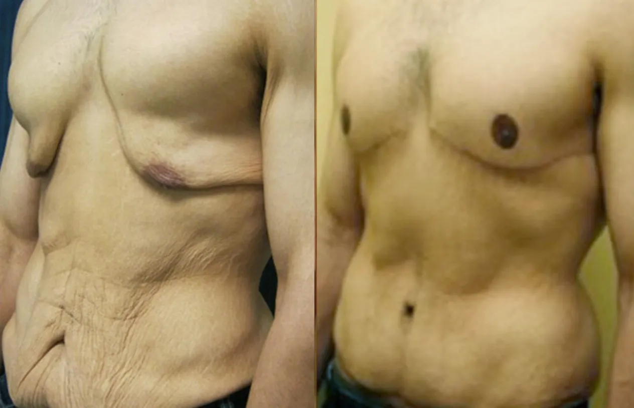 Body Lift — before and after