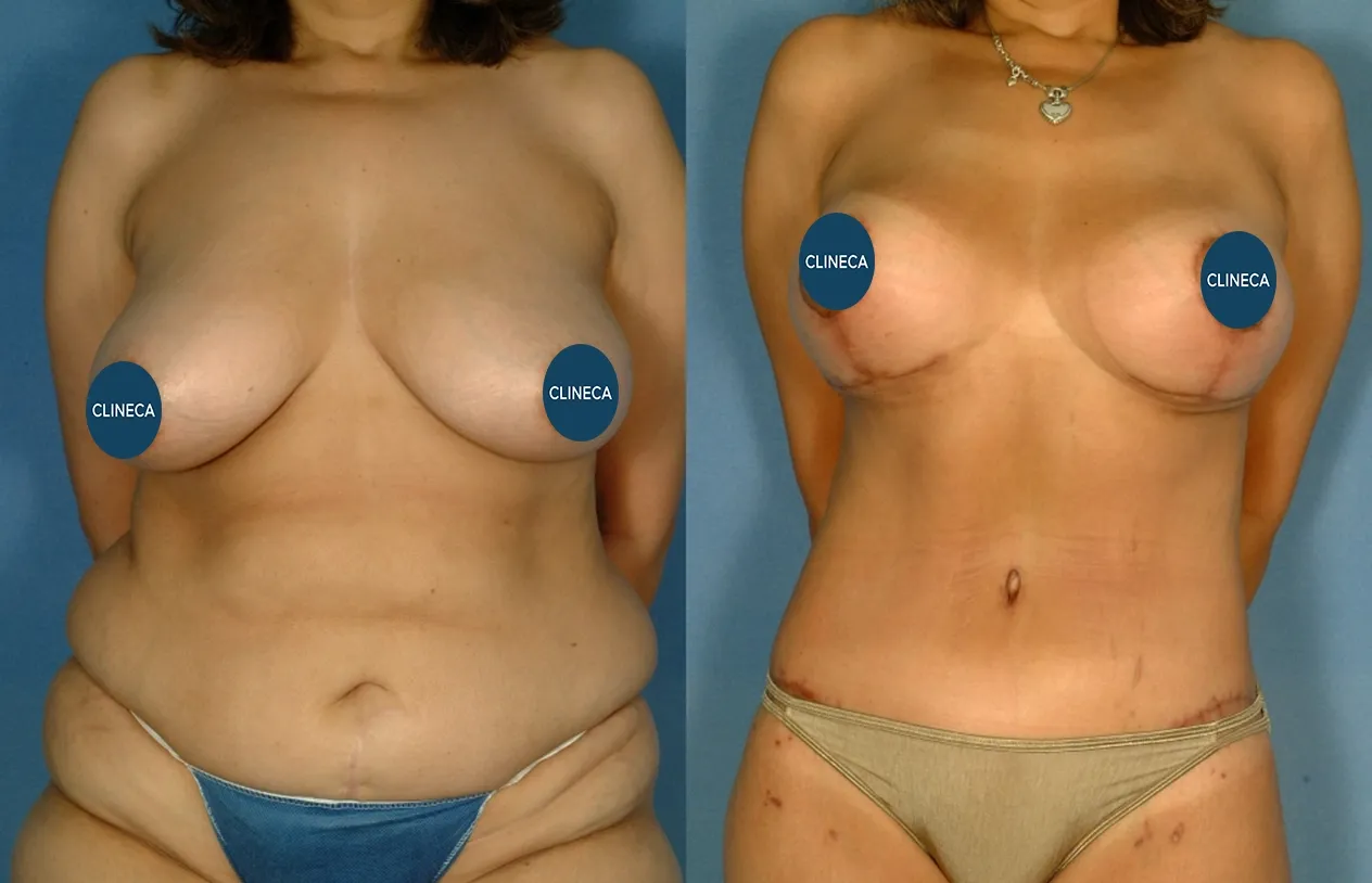 Body Lift — before and after