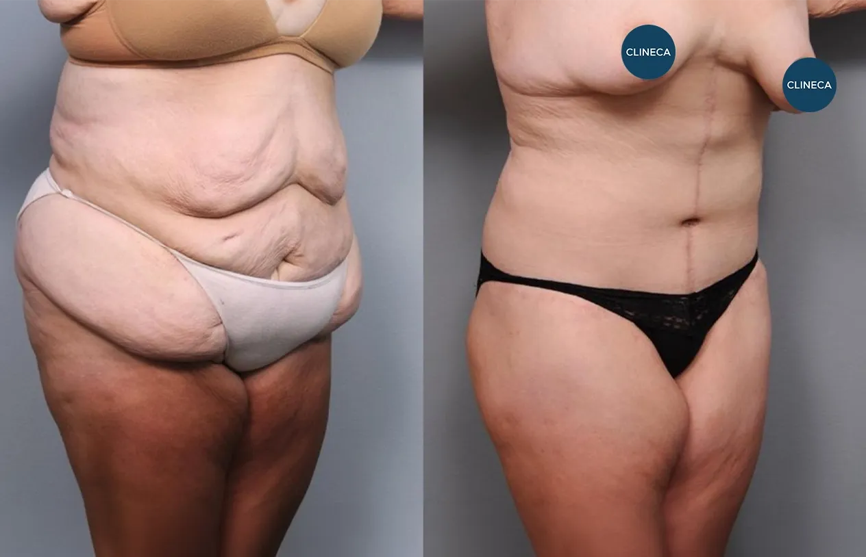 Body Lift — before and after