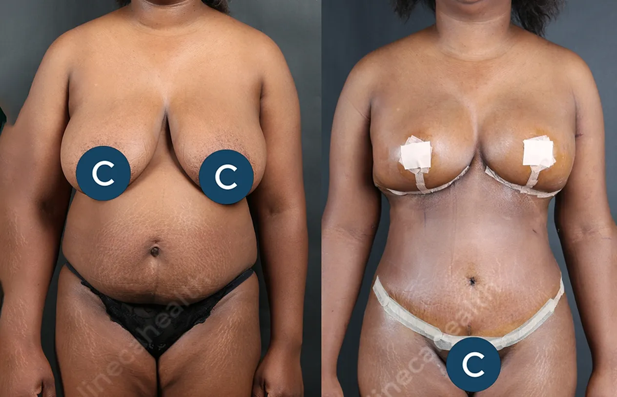 Mommy Makeover — before and after