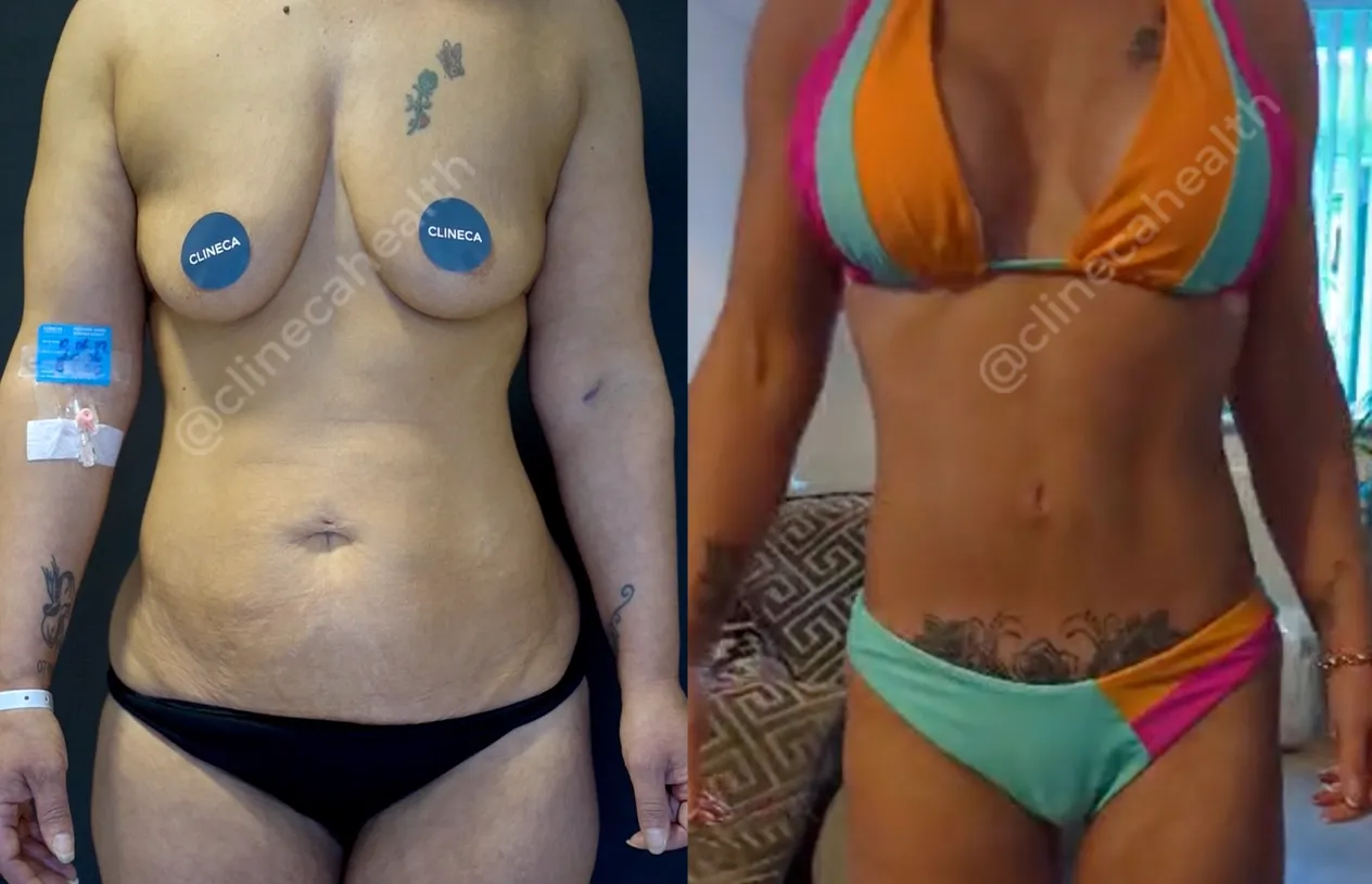 Mommy Makeover — before and after