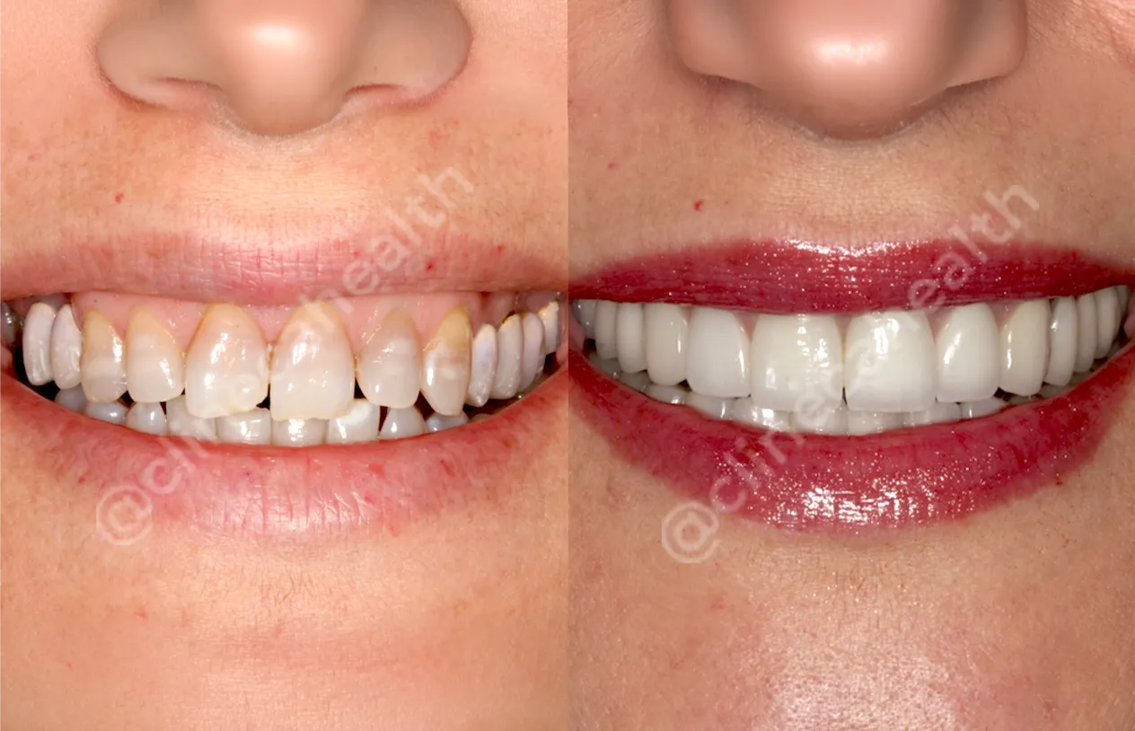 Teeth Veneers — before and after