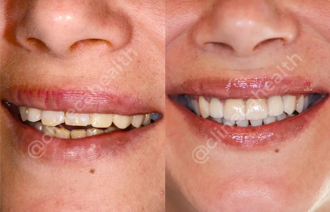 Teeth Veneers — before and after