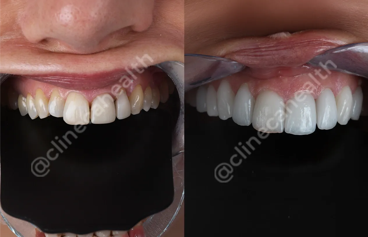 Teeth Veneers — before and after
