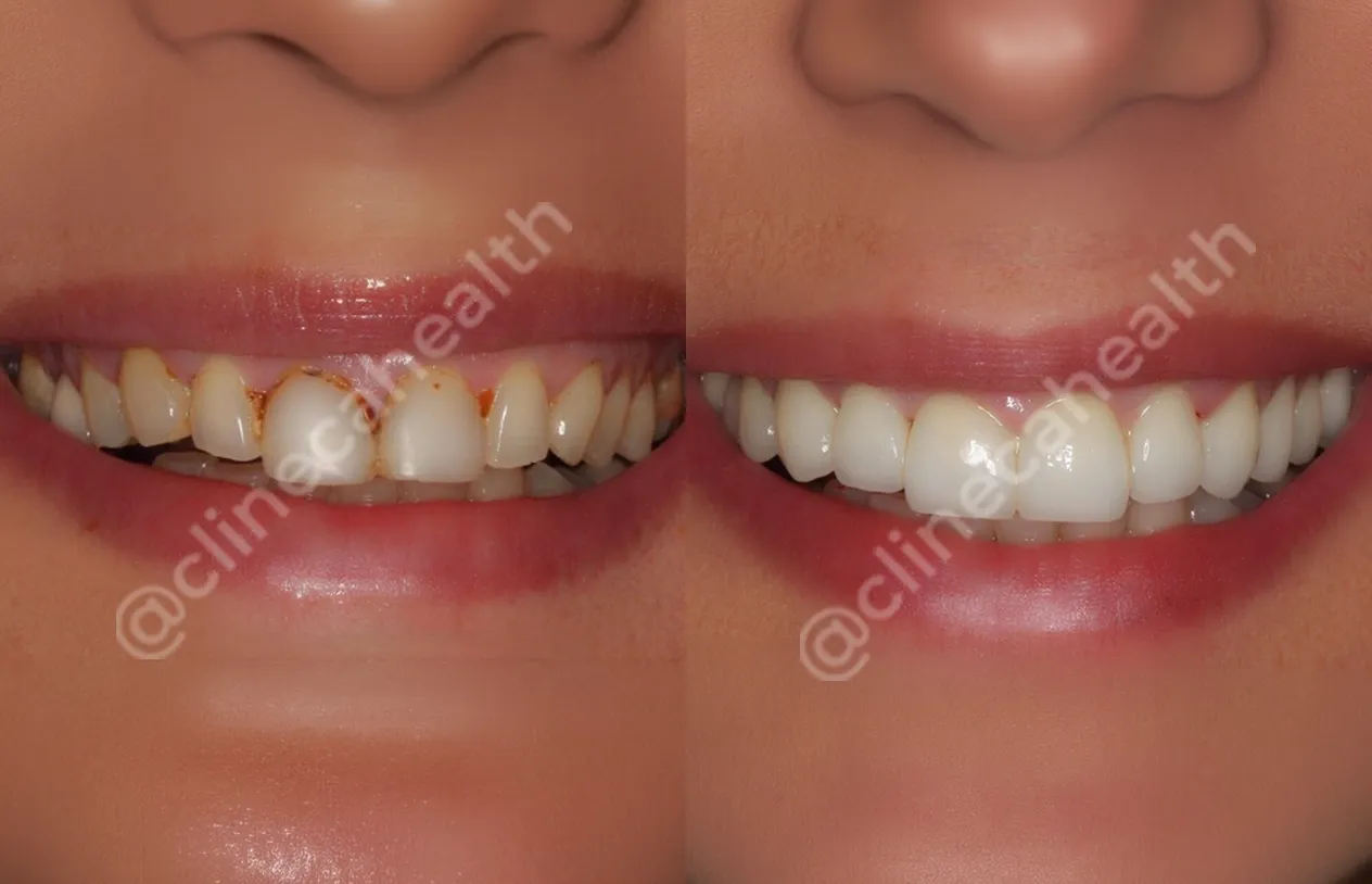 Teeth Veneers — before and after