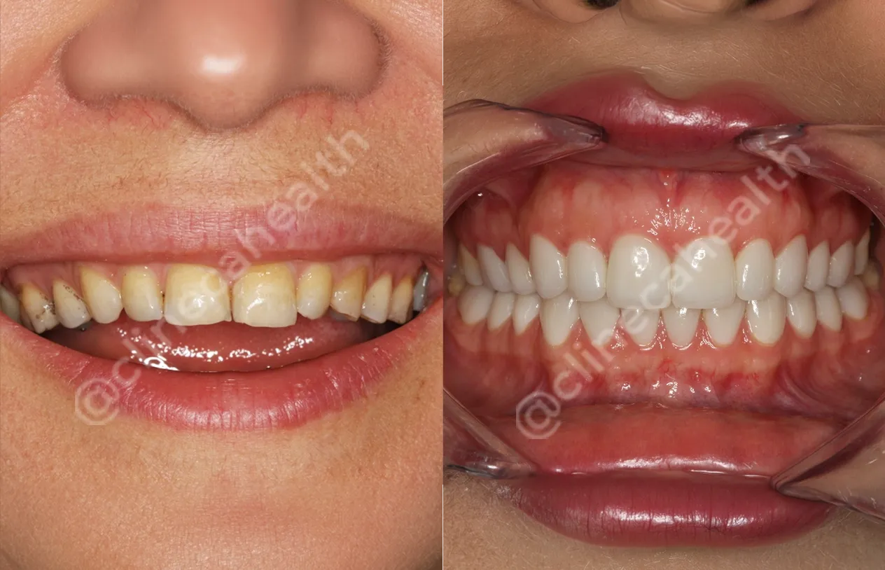 Dental Crowns — before and after