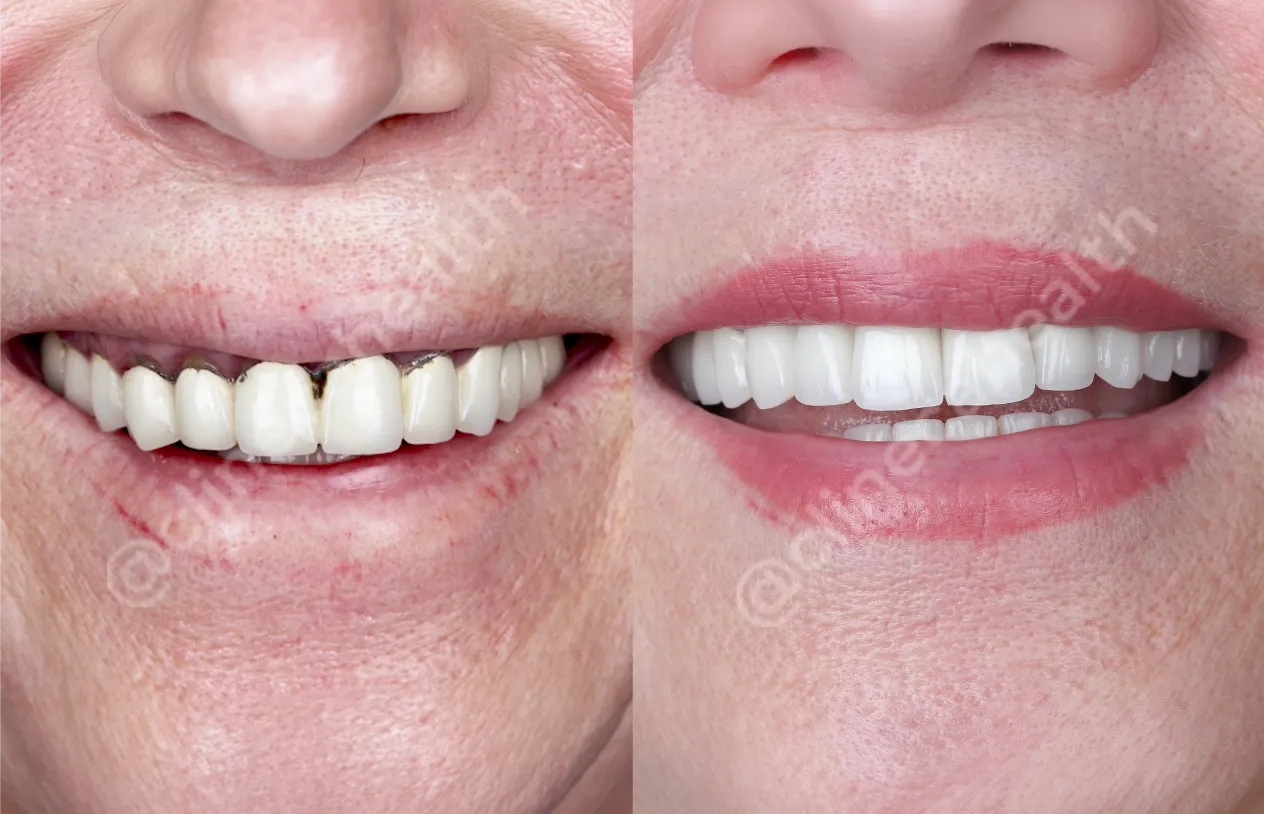 Dental Crowns — before and after