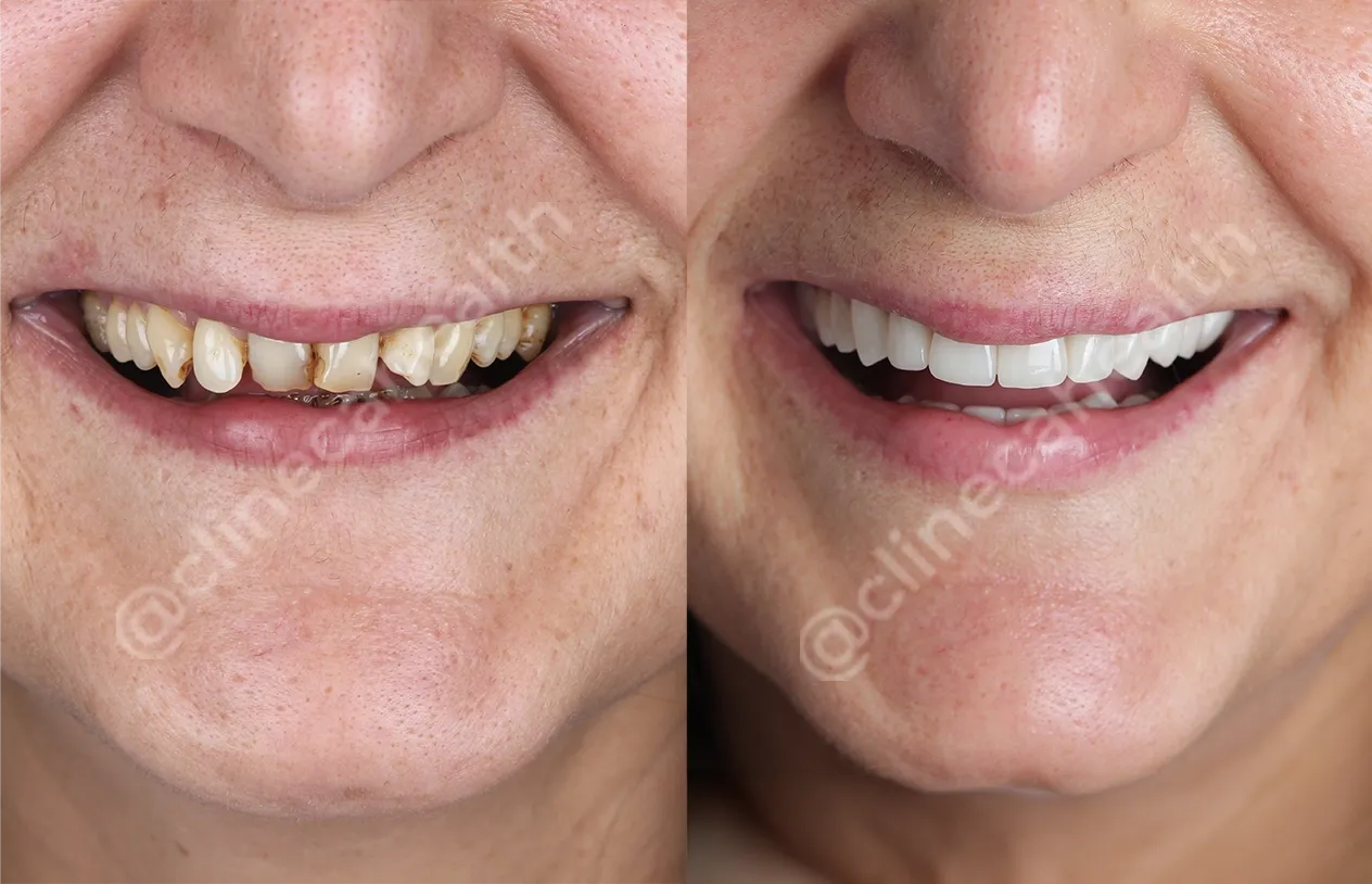 Teeth Veneers — before and after