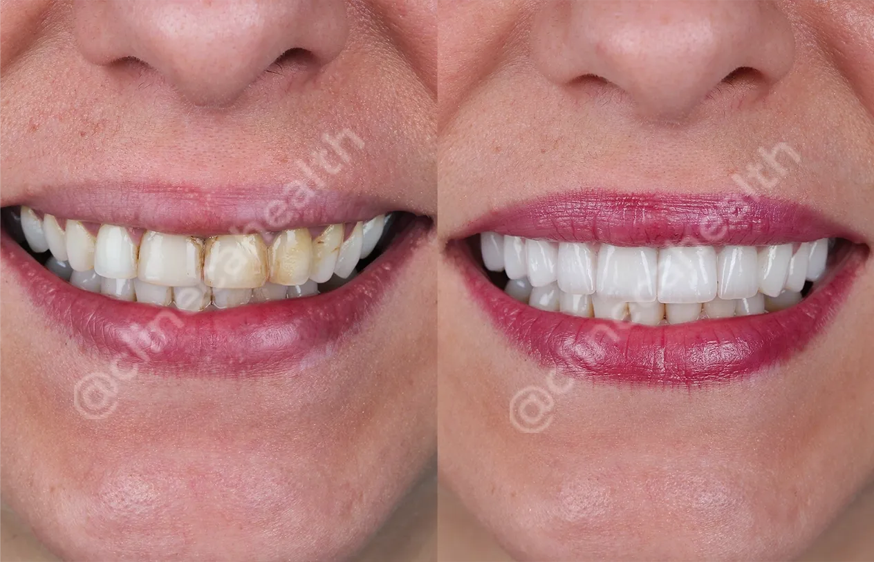 Teeth Veneers — before and after