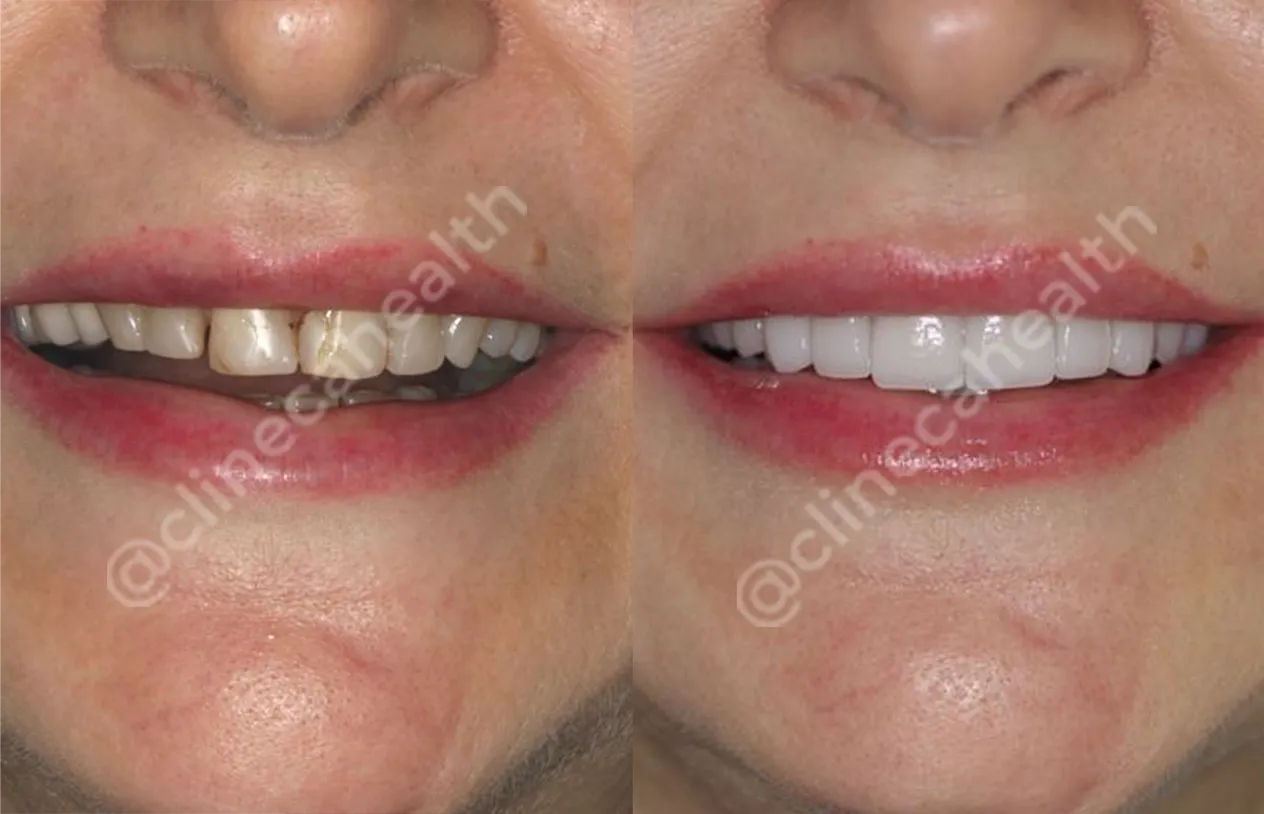 Teeth Veneers — before and after